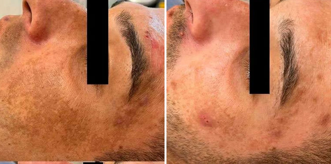 Antes e depois Laser Etherea