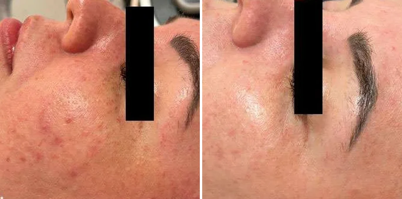 Antes e depois Laser Etherea