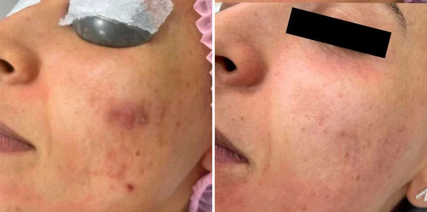 Antes e depois Laser Etherea