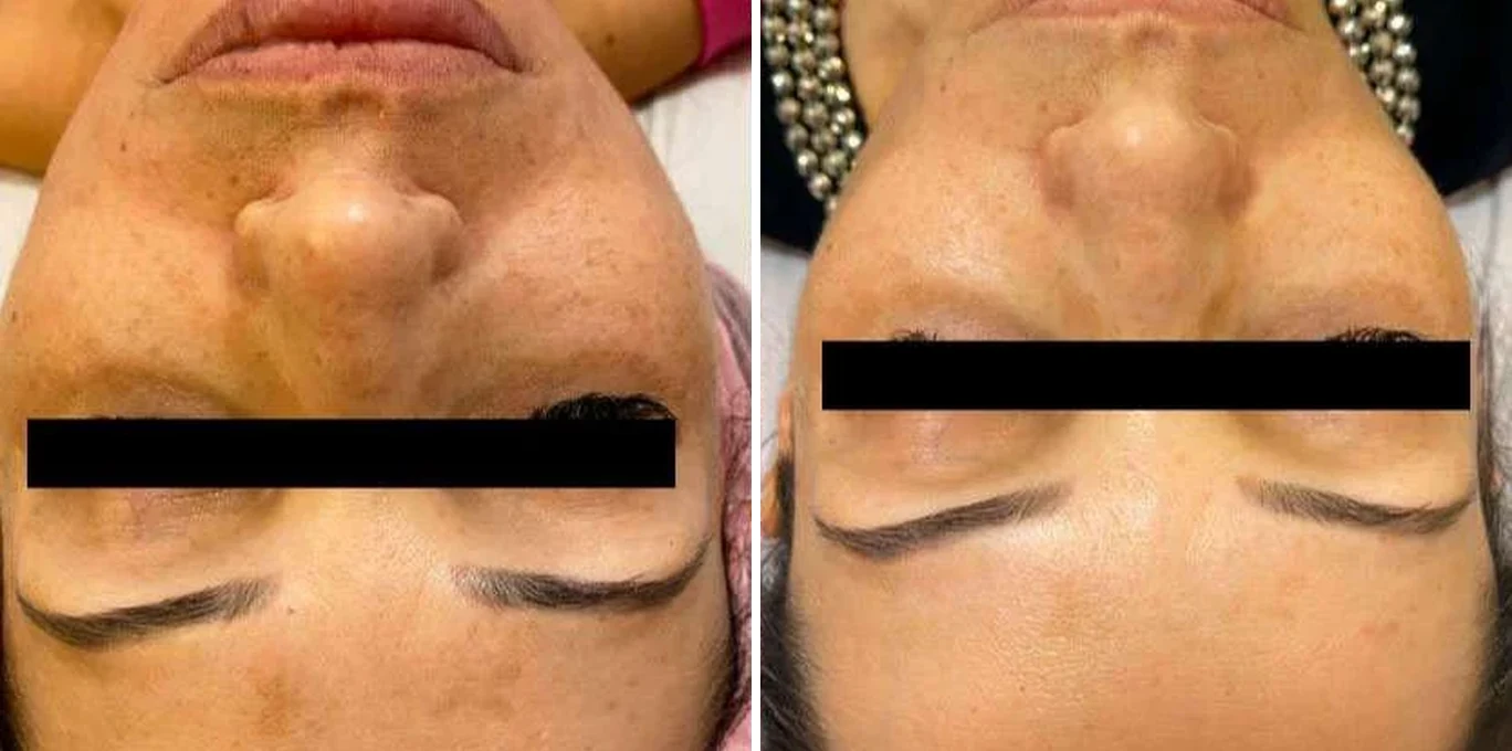 Antes e depois Lavieen — clareamento de manchas