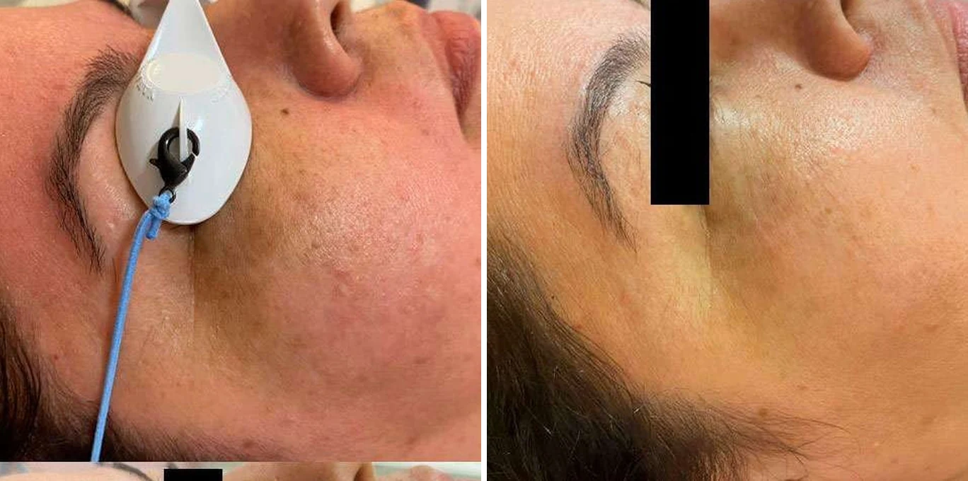 Antes e depois Lavieen — uniformização da pele