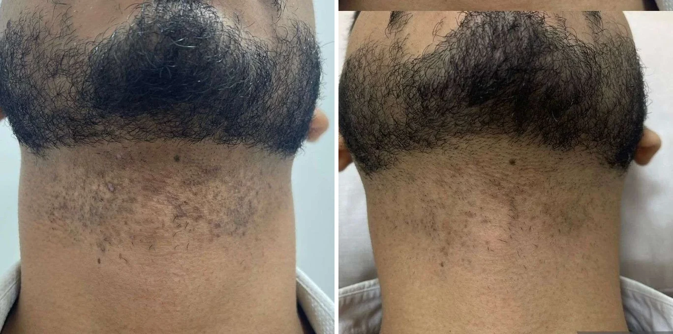 Antes e depois Light Sheer Desire