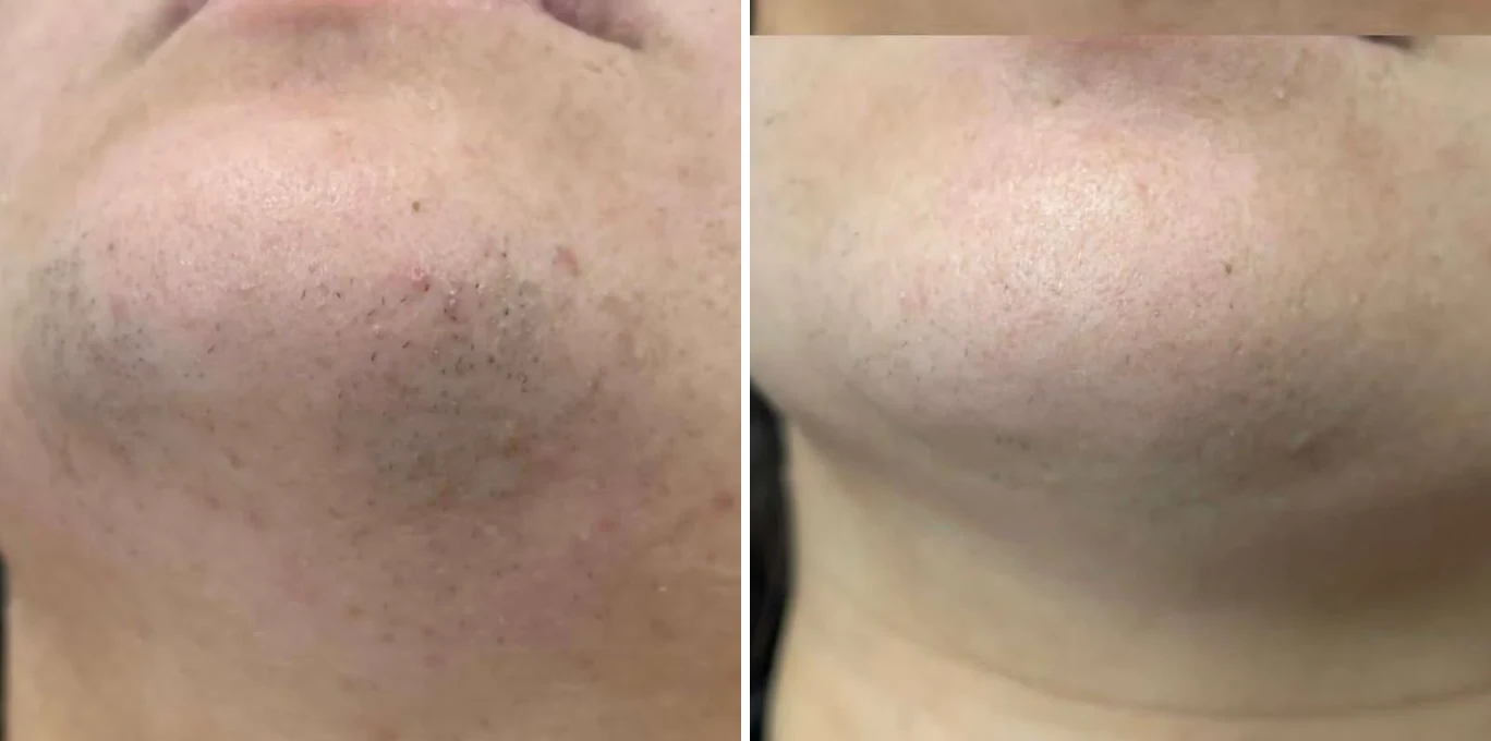Antes e depois Light Sheer Desire