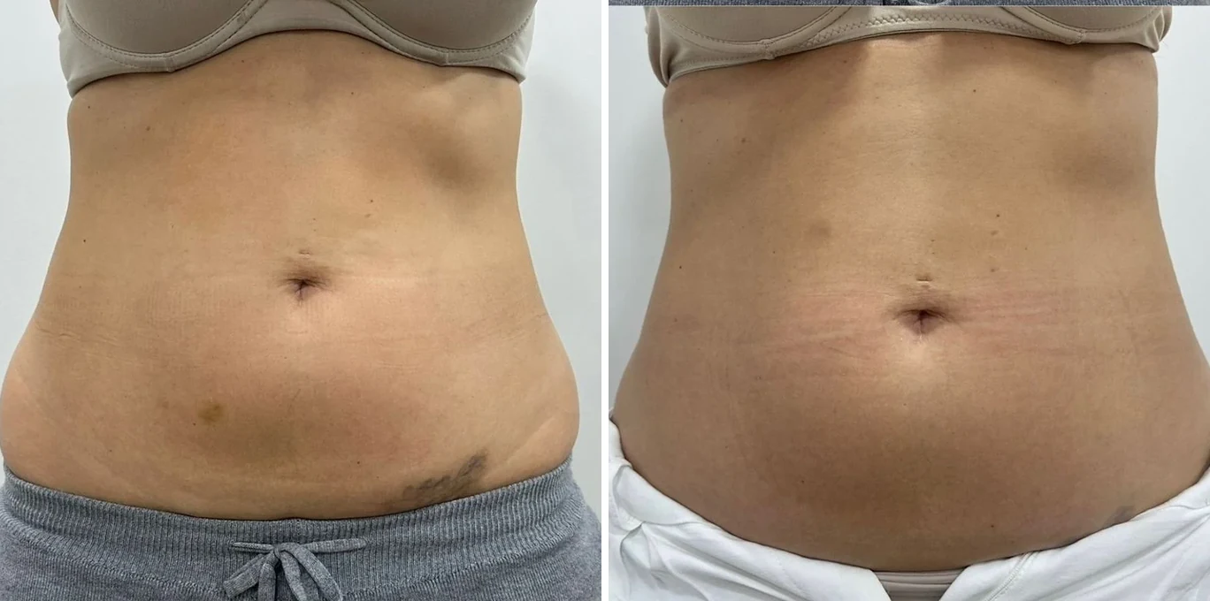 Antes e depois Ultraformer MPT — abdômen