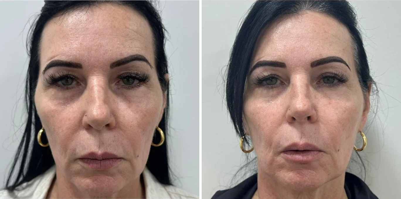 Antes e depois Ultraformer MPT — abdômen